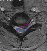 CervicalHernia4