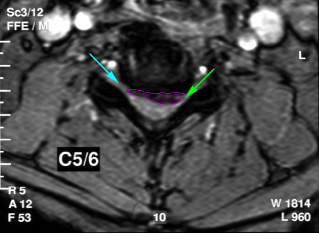 CervicalHernia5