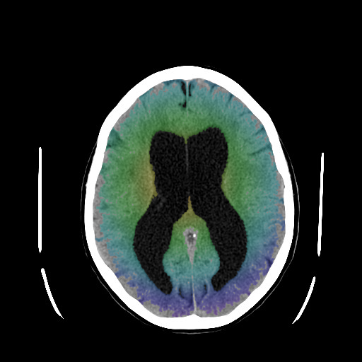 Hydrocephalus-1