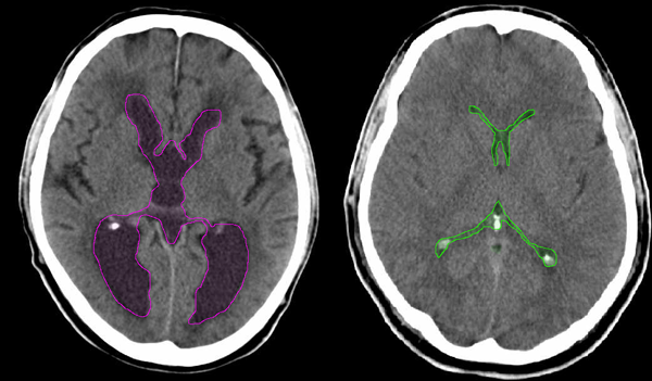 Hydrocephalus2