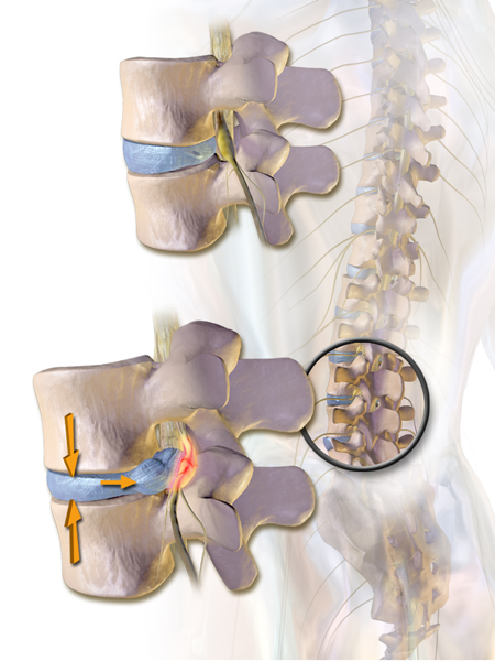 LumbarHernia