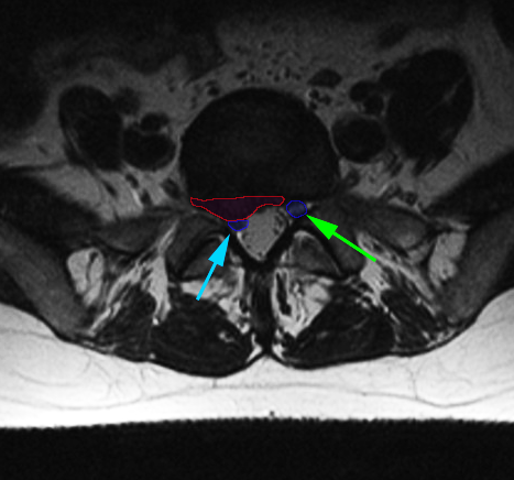 LumbarHernia2rev