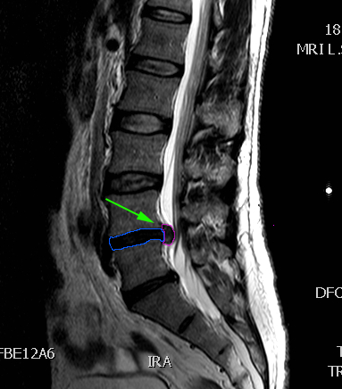 LumbarHernia8