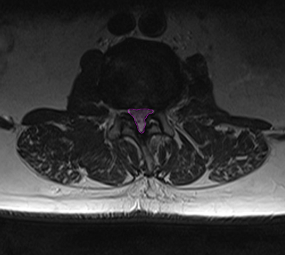 SpinalStenosis