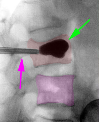 Cyphoplasty2
