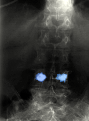 Spondyloplasty1